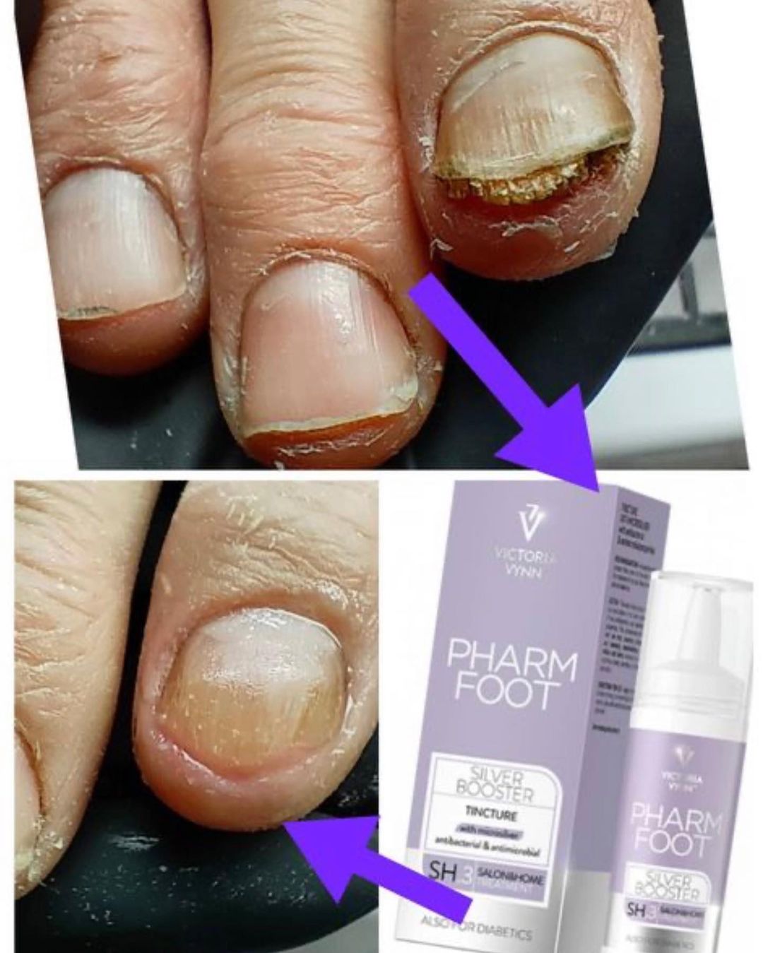 פארם פוט – Pharm Foot | מארז פטרת